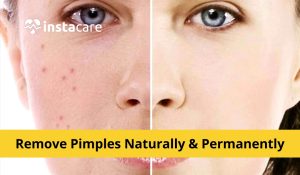 How to Reduce Pimples Naturally